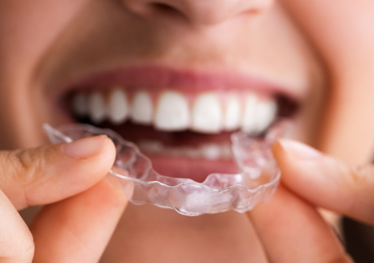 Invisalign Clear Aligners in Coppell TX Area