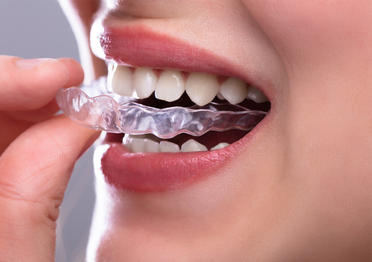 Clear Teeth Aligners in Coppell TX Area
