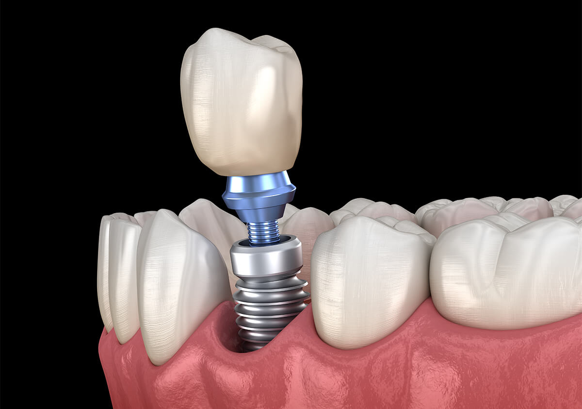 Getting Dental Implants in Coppell TX Area